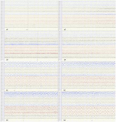 Ketogenic Diet as a Treatment for Super-Refractory Status Epilepticus in Febrile Infection-Related Epilepsy Syndrome